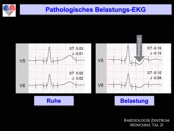 Vergleich von EKG-Aufzeichnungen in Ruhe und unter Belastung. Das Belastungs-EKG zeigt eine ST-Senkung, was auf pathologische Veränderungen hinweist.