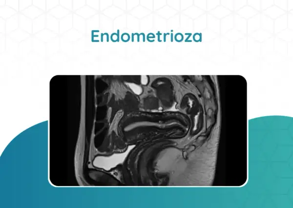 Jakie badanie na endometriozę? Kluczowe metody diagnozowania tej choroby
