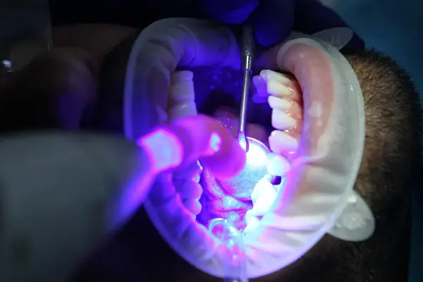 Zabieg stomatologiczny: jak wybielić martwy ząb. Dentysta używa lampy UV i narzędzi do wybielania zęba.