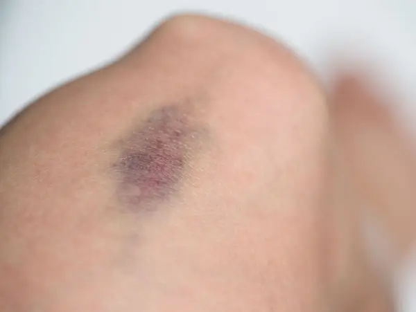 Nahaufnahme eines blauen Flecks am Bein, der auf eine mögliche Thrombose hindeutet.