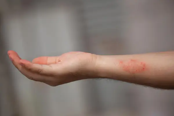Poignet présentant une dartre cutanée rouge et irritée.