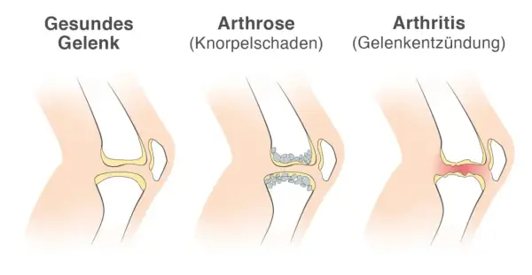 Vergleich von Gelenken: gesund, Arthrose (Knorpelschaden) und Arthritis (Gelenkentzündung). Arthritis zeigt eine Entzündung im Gelenk.