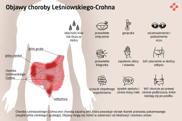 Ilustracja przedstawia objawy choroby Leśniowskiego-Crohna: zmęczenie, gorączkę, biegunkę, ból brzucha, problemy z oczami i skórą.