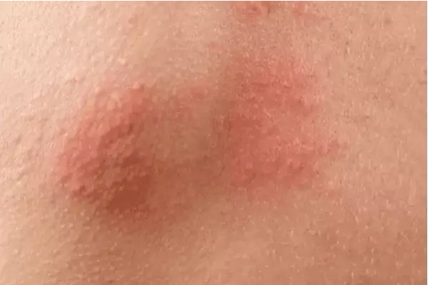 Uczulenie na perfumy: jak rozpoznać objawy i uniknąć reakcji alergicznych