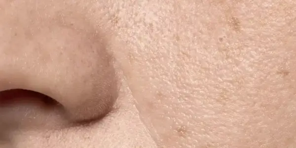 Primer plano de la piel, mostrando la textura y los poros visibles. Se aprecian pequeñas imperfecciones y la delicada superficie.