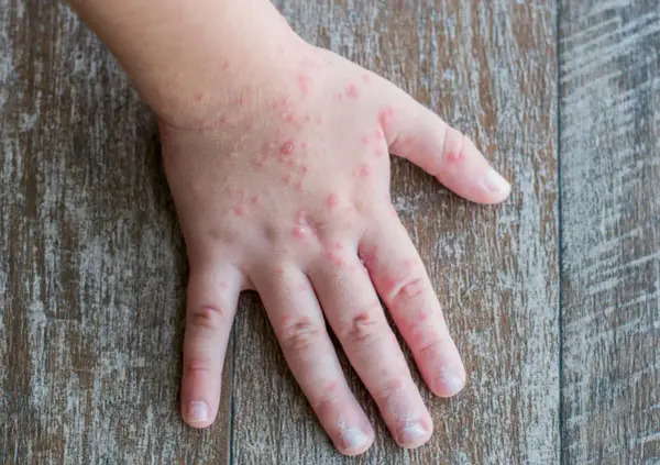 Mani di bambini con eruzioni cutanee rosse, simili a quelle che a volte compaiono su bocca e piedi.