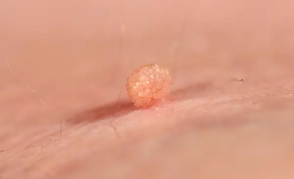 HPV u dziecka - brodawki, objawy i szczepienie