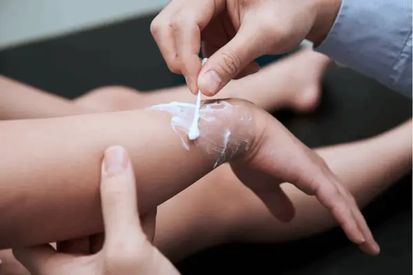 Delikatne smarowanie oparzonej skóry kremem na oparzenia za pomocą patyczka kosmetycznego.