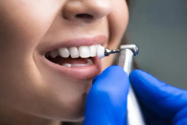 Denti bianchi e sani dopo la detartrasi ultrasuoni. Un dentista con guanti blu pulisce i denti con uno strumento rotante.
