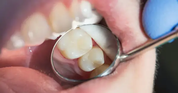Stomatolog bada zęby, szukając próchnicy ukrytej. Widać fragment jamy ustnej, zęby i lusterko dentystyczne.