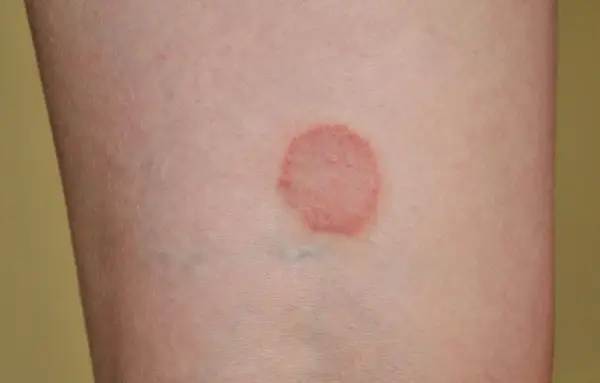 Liszaj na nodze - Jak rozpoznać i leczyć? Poradnik dermatologa