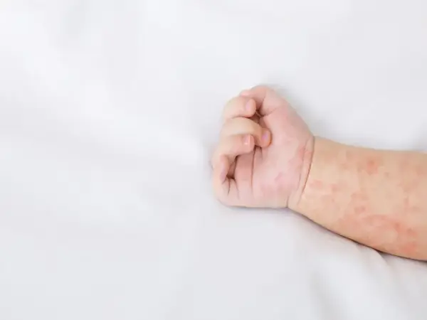 Ręka niemowlaka z zaczerwienioną wysypką. Skóra pokryta jest drobnymi, różowymi plamkami, które mogą świadczyć o alergii lub chorobie.