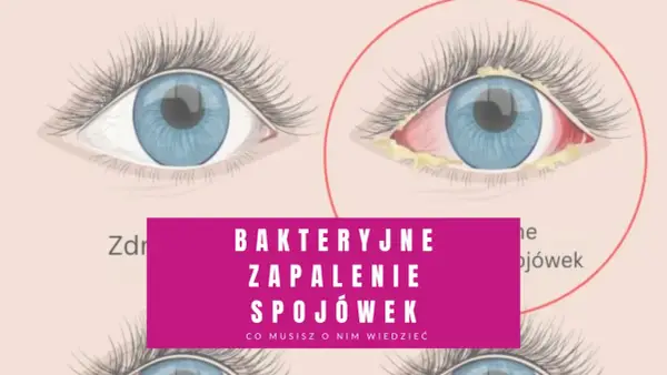 Zdrowe oko obok oka z objawami bakteryjnego zapalenia spojówek: zaczerwienienie, obrzęk i wydzielina.