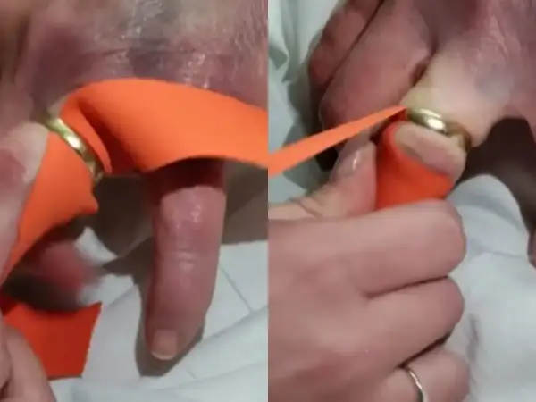 Jak zdjąć pierścionek ze spuchniętego palca - bezpiecznie!