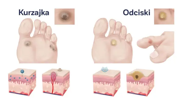 Ilustracja porównuje kurzajki i odciski na stopach. Odcisk na stopie po angielsku to "corn".