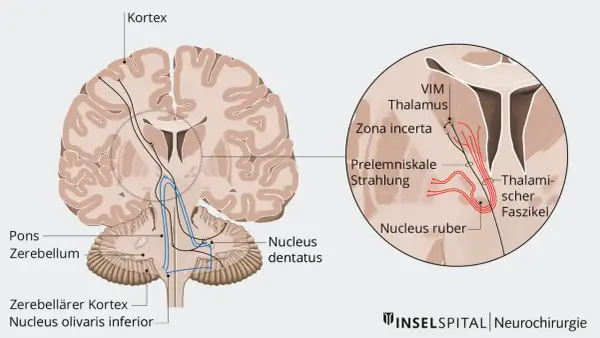 Hirnschnitt mit Darstellung von Nervenbahnen, die vom Kortex zum Thalamus und Kleinhirn verlaufen. Der primäre Fokus liegt auf dem Thalamus und seinen Verbindungen.