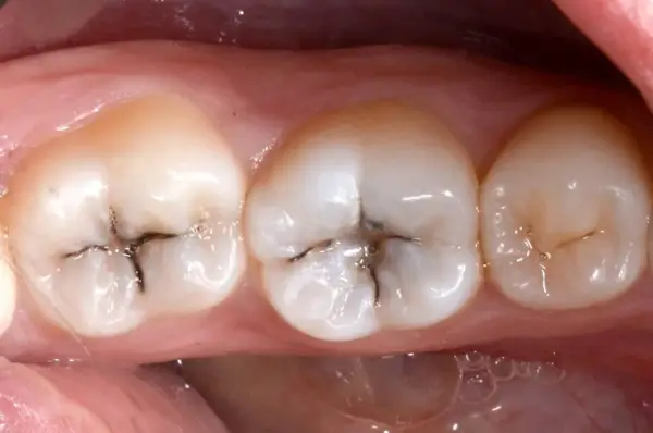 Denti con piccole carie scure nelle fessure.