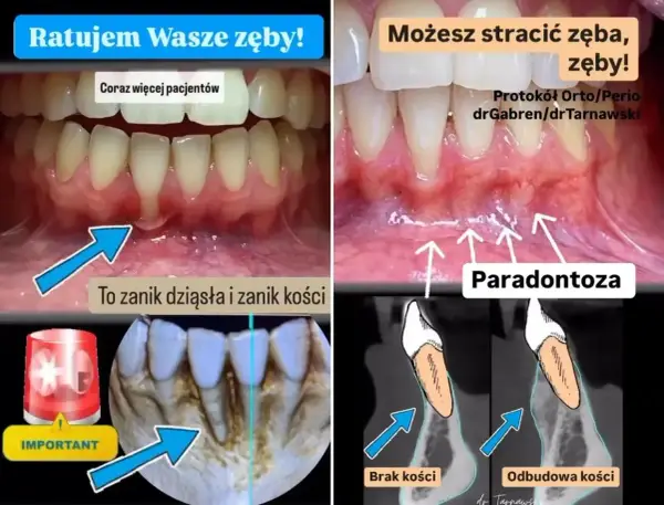 Zanikanie dziąseł i kości (paradontoza) może prowadzić do utraty zębów. Sprawdź, jaka jest recesja dziąseł cena leczenia.