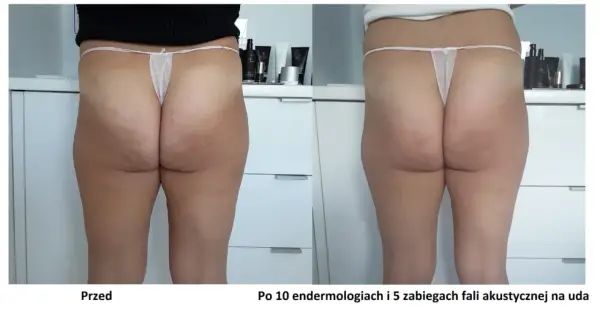 Widoczne efekty endermologii po 10 zabiegach i 5 fal akustycznych na uda. Skóra na pośladkach i udach jest gładsza, cellulit zredukowany.