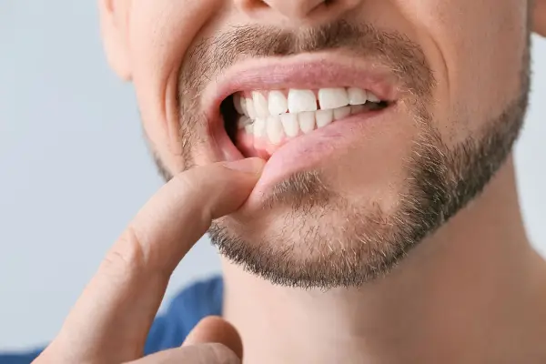 Diastema - Kiedy szpara między zębami to problem?