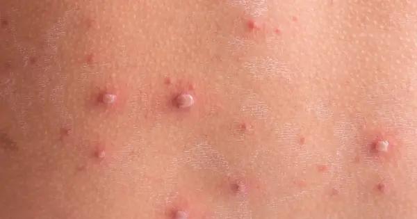Zmiany skórne po ospie. Jak przyspieszyć gojenie ospy? Widoczne pęcherzyki i zaczerwienienia na skórze.