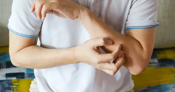HIV objawy skórne - Jak je rozpoznać i kiedy zrobić test?