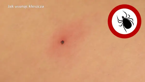 Jak wygląda mały kleszcz? Rozpoznaj go i uniknij niebezpieczeństwa!