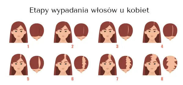 Łysienie androgenowe u kobiet: objawy, przyczyny i wpływ