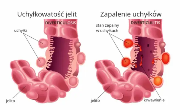 Zapalenie uchyłka jelita objawy - rozpoznaj ból i inne symptomy