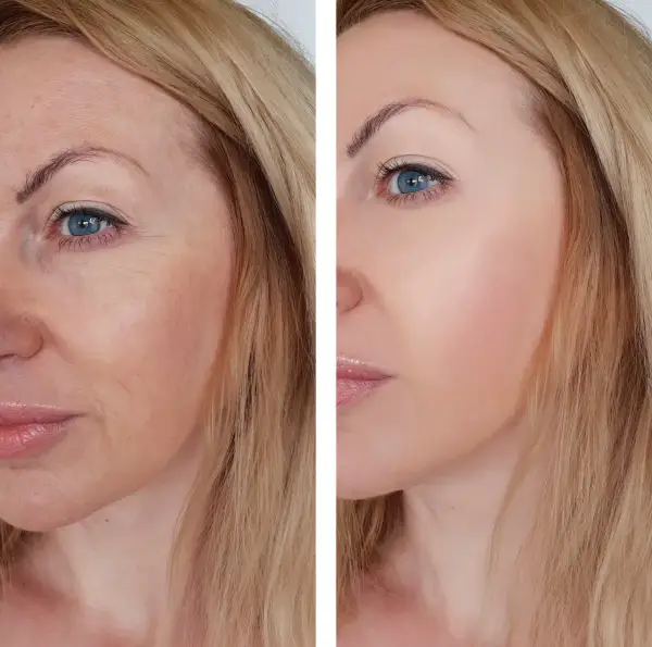Peeling z retinolem: opinie, efekty i skutki uboczne zabiegu