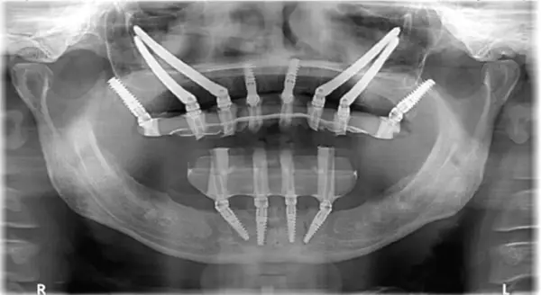 Radiografia panoramica mostra impianti dentali posizionati in arcate mascellari con ridotta quantità di osso, una soluzione per chi necessita di impianti dentali senza osso.