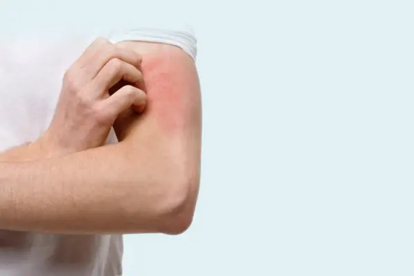 Un bras rouge et irrité se gratte, une sensation de chatouillement sur la peau qui devient insupportable.