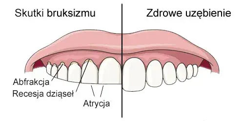 Co oznacza zgrzytanie zębami przez sen i jak temu zapobiec
