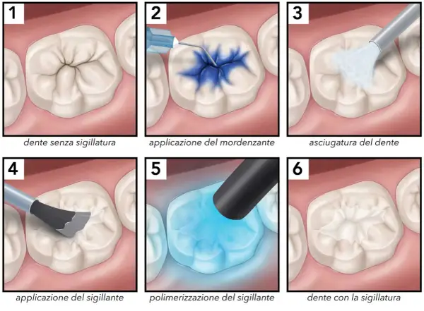 Illustrazione dei passaggi per sigillare i solchi dei denti, dalla preparazione all'applicazione del sigillante.