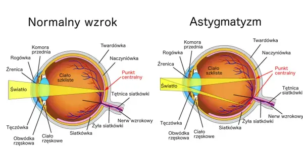 Astygmatyzm - Domowe sposoby - Co naprawdę działa?
