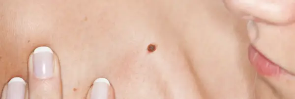 Gros plan sur une peau humaine, montrant une texture légèrement granuleuse, un grain de beauté brun et le bord des lèvres.