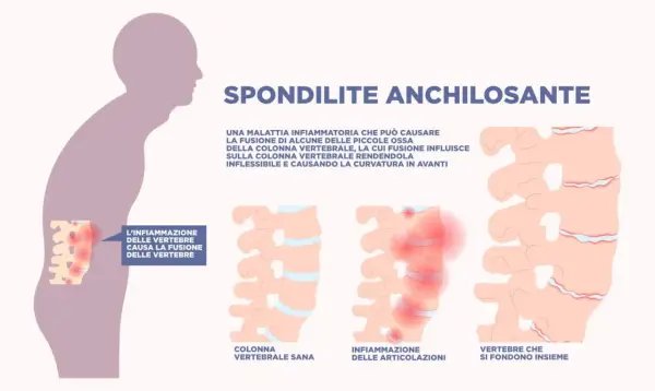 Spondilite anchilosante: infiammazione vertebrale che causa fusione ossea, rendendo la colonna rigida e curva in avanti.