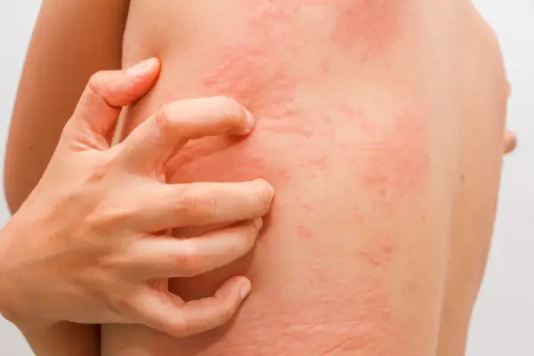 Reakcja skórna po lekach - kiedy to alergia, a kiedy infekcja?