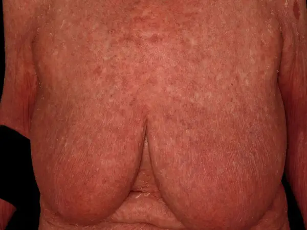 Hautveränderungen, die auf Pityriasis rubra pilaris hindeuten, zeigen sich als rote, schuppende Flecken auf der Brust und den Armen.