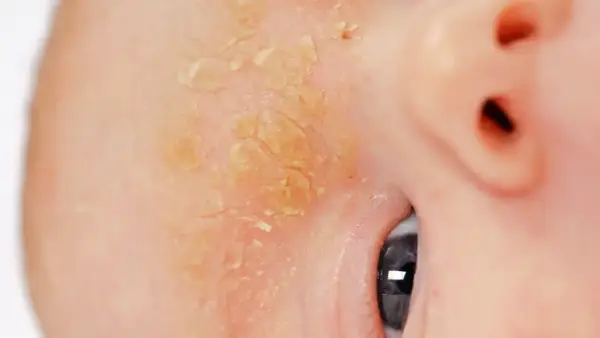Liszaje - jak odróżnić i skutecznie leczyć? Poradnik dermatologa