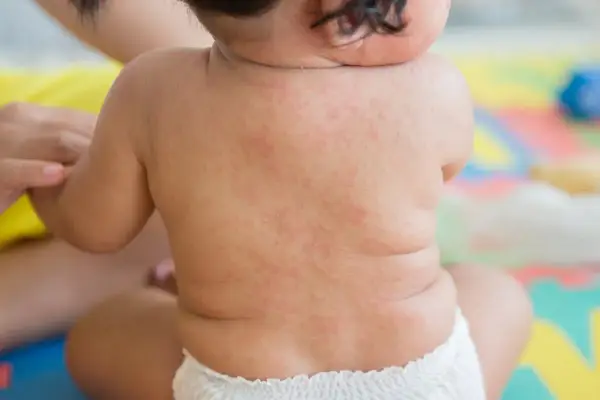 Baby's Rücken zeigt einen roten Ausschlag, möglicherweise nach 3 Tagen Fieber.