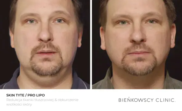 Lipoliza iniekcyjna - Czy to sposób na oporny tłuszcz?