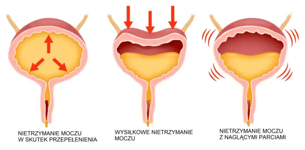 Ilustracja pokazuje trzy rodzaje nietrzymania moczu: przepełnienie, wysiłkowe i nagłe parcia. Taśma tot może pomóc w niektórych przypadkach.