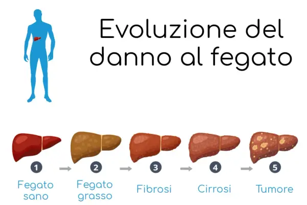 Evoluzione del danno epatico: da fegato sano a fegato grasso, poi fibrosi, cirrosi e infine tumore.