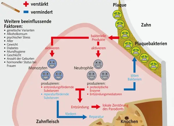 Das Diagramm zeigt, wie sich das Zahnfleisch nach Rauchstopp regeneriert. Es erklärt die Rolle von Monozyten und Neutrophilen bei Entzündung und Reparatur.