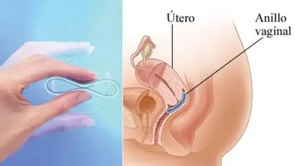 Anillo vaginal anticonceptivo en mano y su ubicación en el útero. No se debe quitar el anillo anticonceptivo durante relaciones.