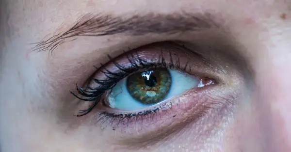 Nahaufnahme eines Auges mit einem leicht geschwollenen Augenlid. Die Iris ist grünlich-braun mit feinen Sprenkeln.