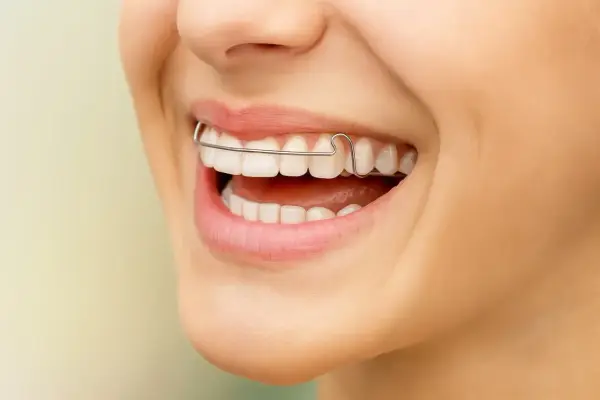 Retainer po aparacie - Klucz do trwałego uśmiechu?
