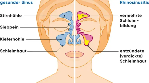 Vergleich gesunder Sinus und Rhinosinusitis: Entzündete Schleimhaut und vermehrte Schleimbildung sind typische nasennebenhöhlenentzündung symptome.