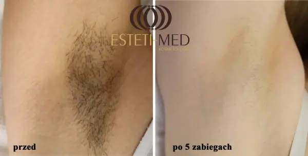 Depilacja laserowa - Co ile zabieg? Maksymalizuj efekty!